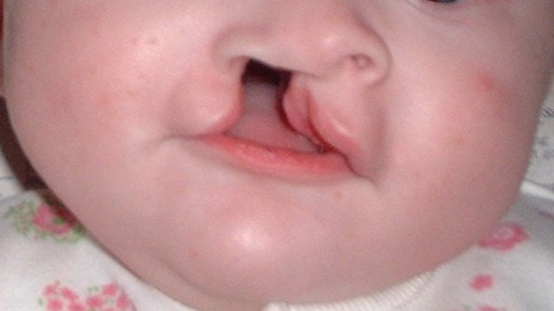 Fem m&aring;naders flicka med l&auml;pp-, k&auml;k- och gomspalt.