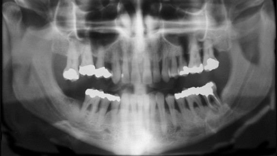 Röntgenbild på paradontit.
